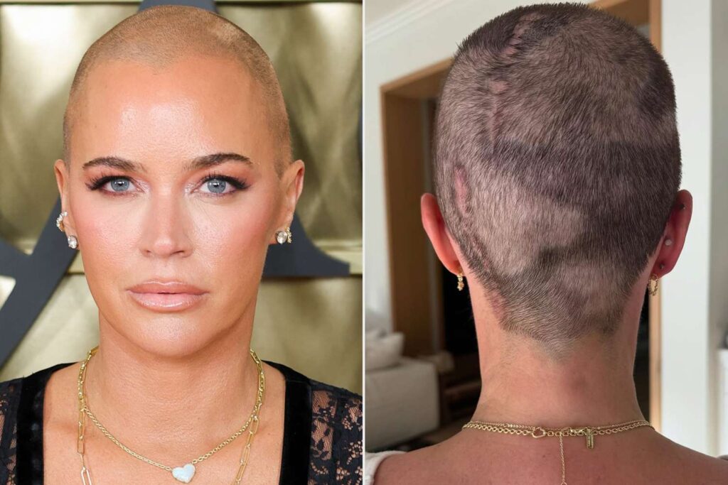 Teddi Mellencamp muestra un cambio real en el crecimiento del cabello tras cirugía de cáncer cerebral
