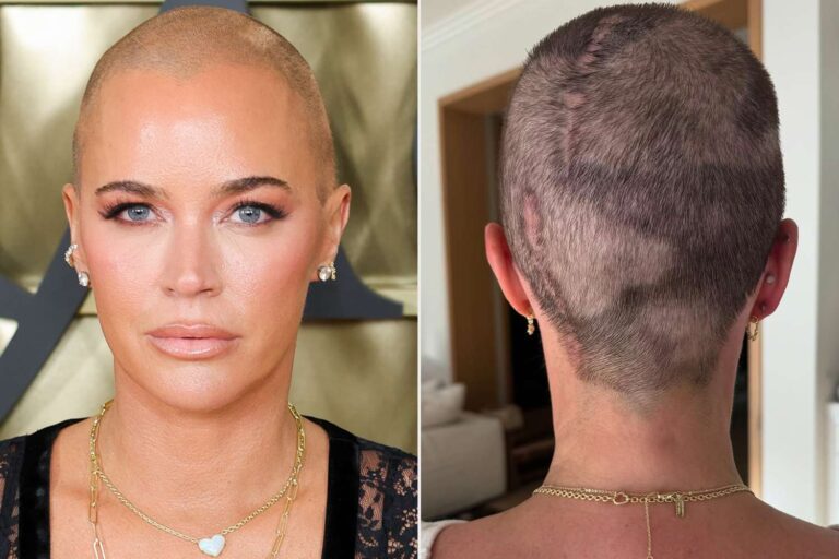 Teddi Mellencamp muestra un cambio real en el crecimiento del cabello tras cirugía de cáncer cerebral