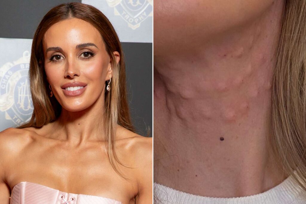 Modelo muestra su cuello cubierto de bultos tras someterse a un procedimiento estético inspirado en el look juvenil de Kris Jenner