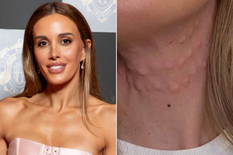 Modelo muestra su cuello cubierto de bultos tras someterse a un procedimiento estético inspirado en el look juvenil de Kris Jenner