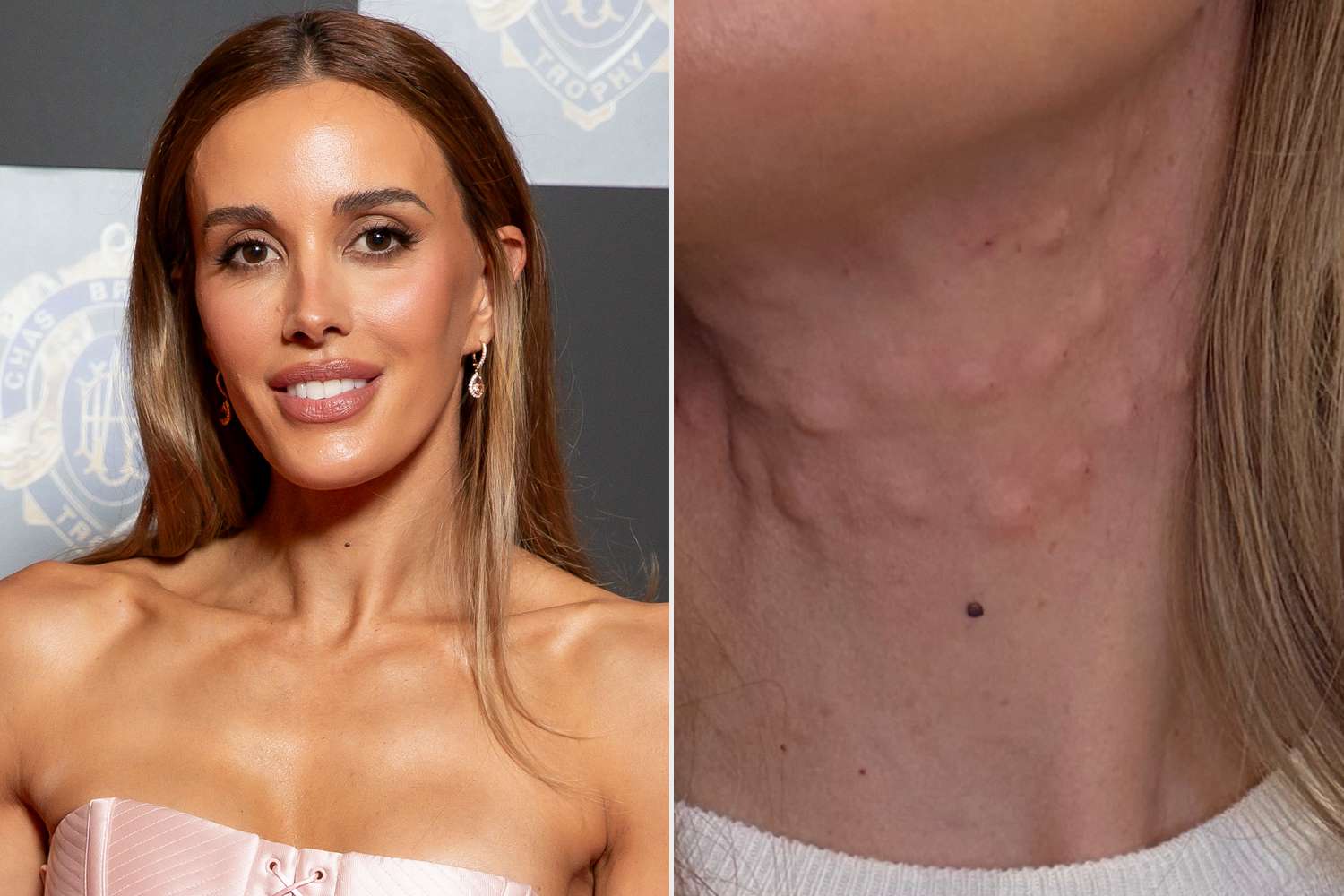 Modelo muestra su cuello cubierto de bultos tras someterse a un procedimiento estético inspirado en el look juvenil de Kris Jenner
