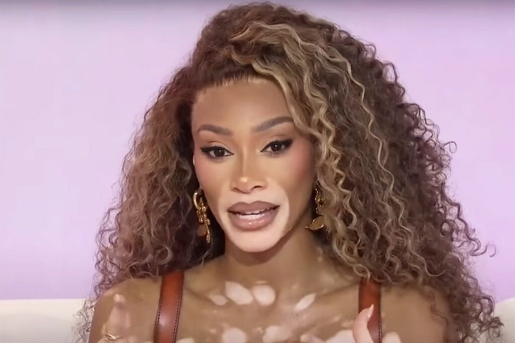 Winnie Harlow emociona al ver videos de otras mujeres con vitiligo: 'Me he convertido en la hermana mayor que siempre quise'