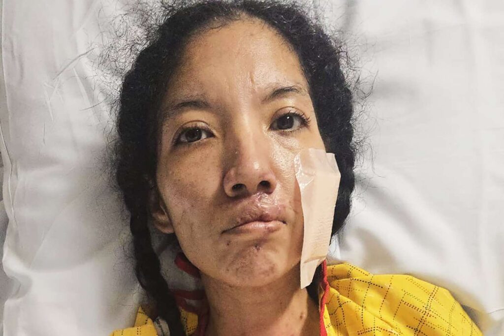 Madre de dos hijos con autismo pierde extremidades tras enfermedad que devora carne: 'No puedo cuidar a mis hijos'